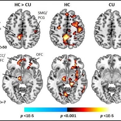 This shows brain scans from teen cannabis users