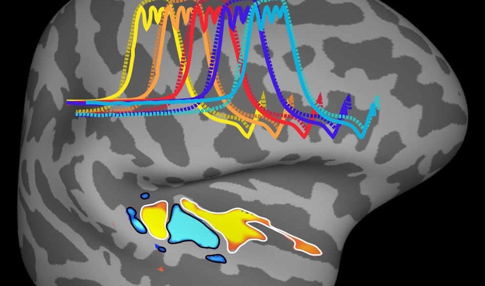 The auditory cortex is highlighted in this brain scan