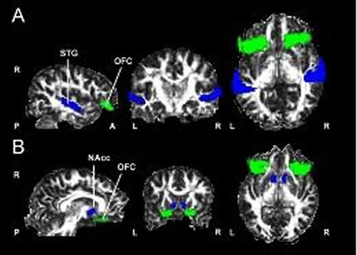 This shows brain scans