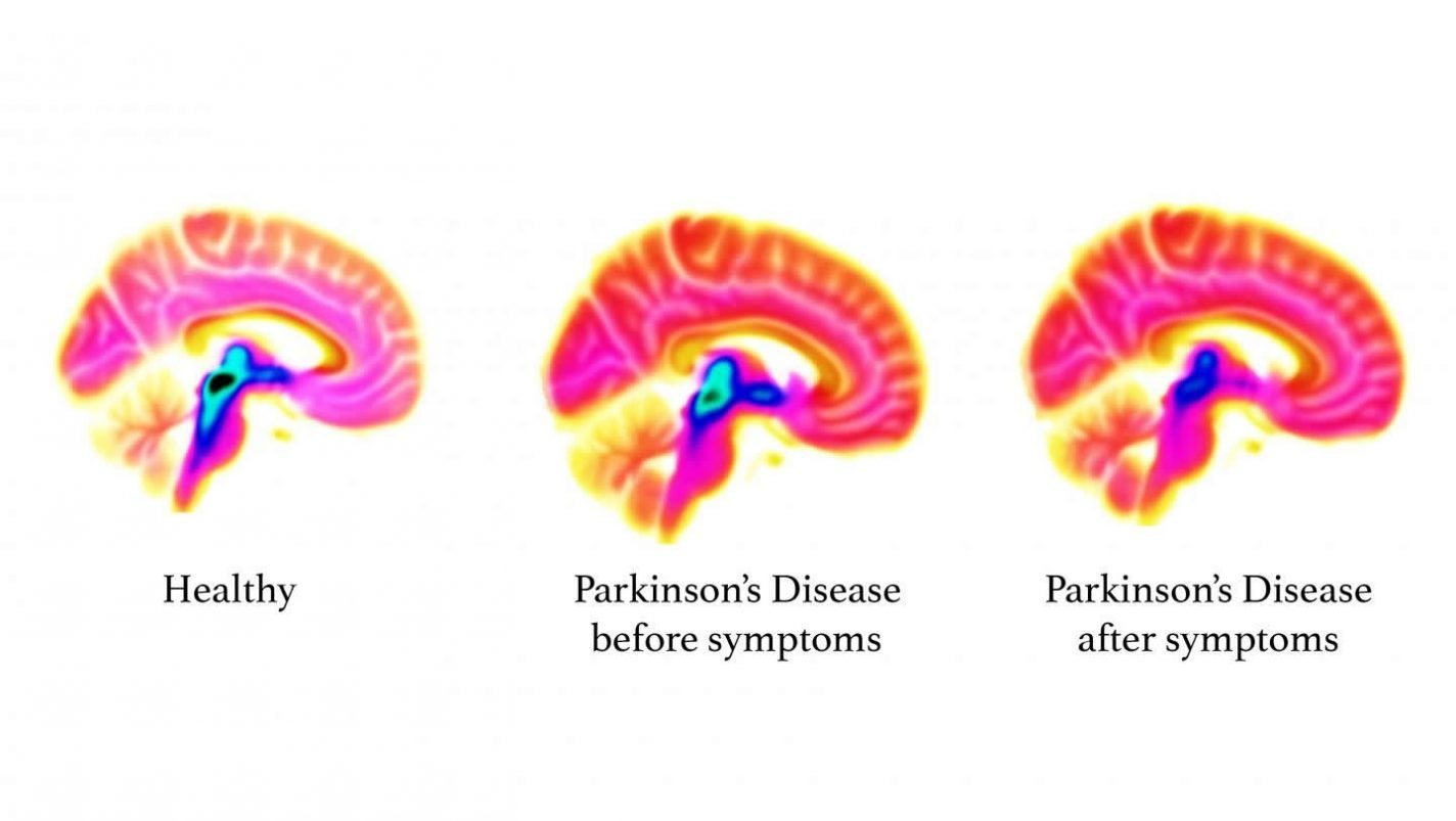This shows PET scans of a Parkinsons brain