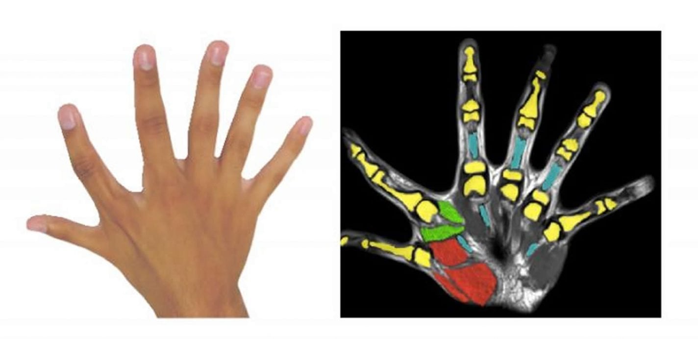 This shows a hand with 6 fingers