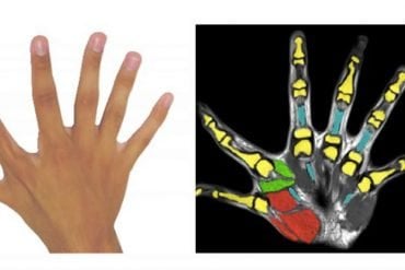 This shows a hand with 6 fingers