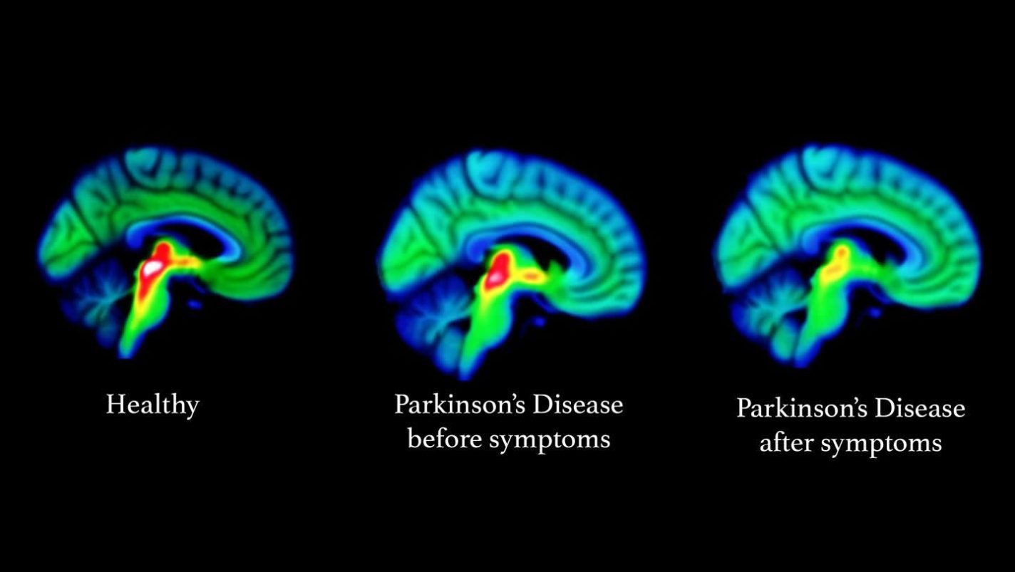 This shows blue parkinson's brains