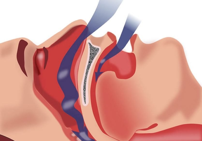 This shows a diagram of the airway while sleeping