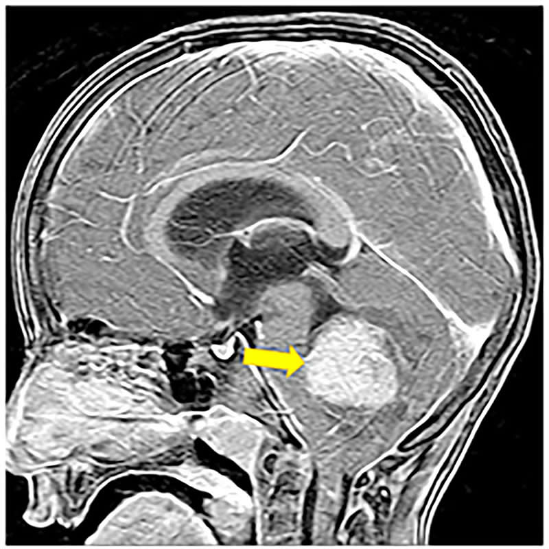 This shows a medulloblastoma in a brain scan