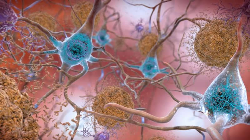 This is an illustration of amyloid beta in neurons