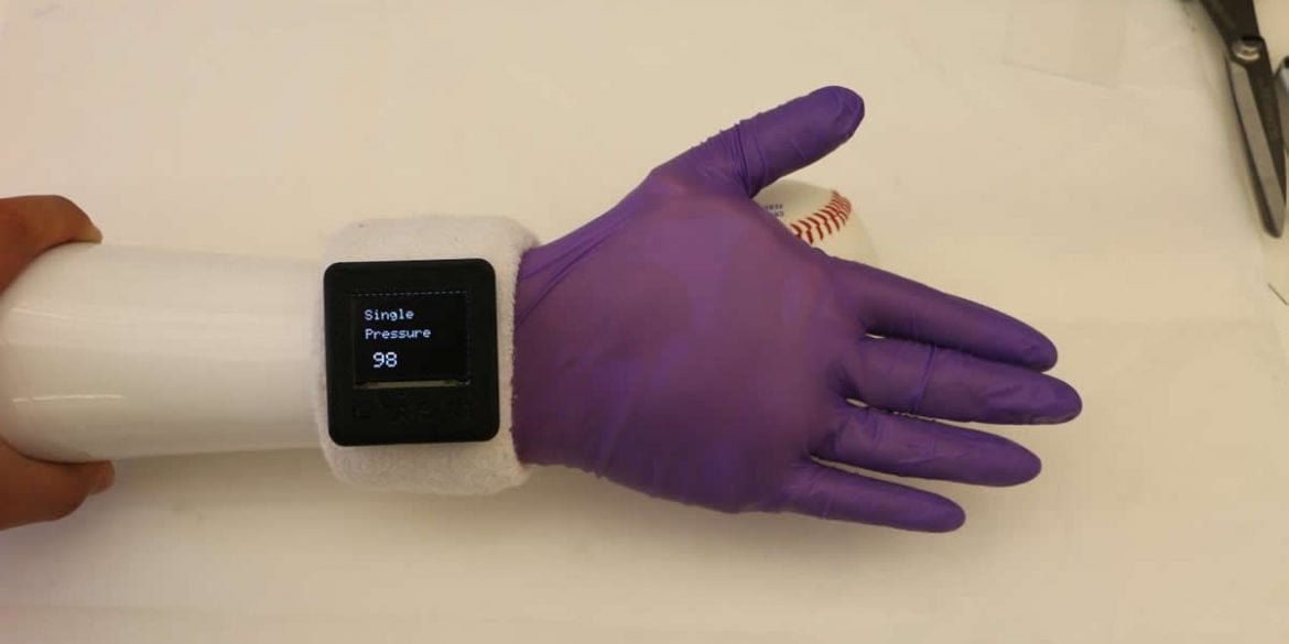 This shows a prosthetic hand with the glove and watch