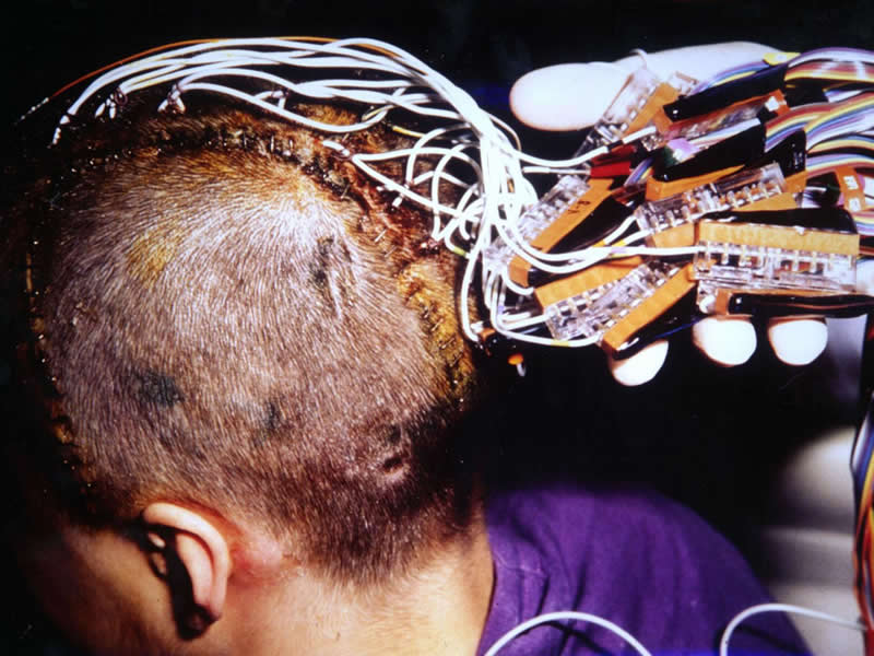 This shows a patient with electrodes on his head