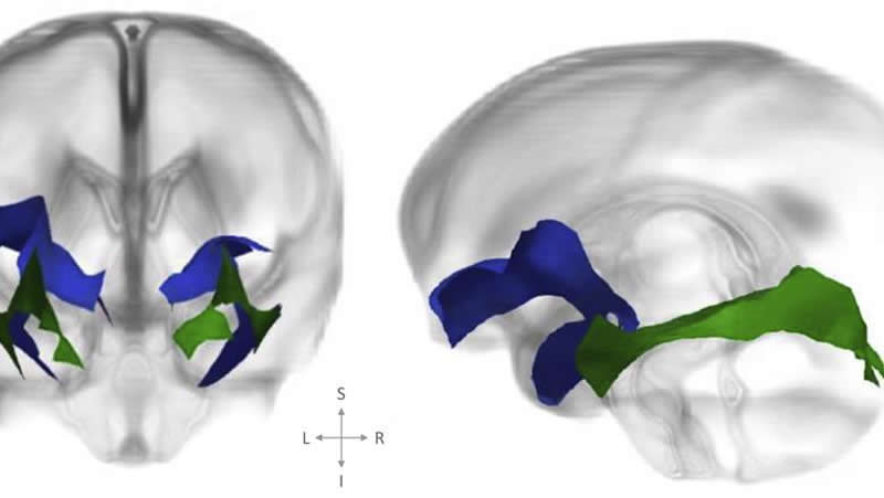 This shows the DTI of the white matter tracts