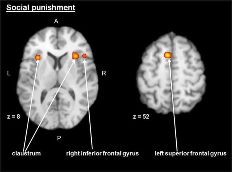 superior frontal gyrus mri