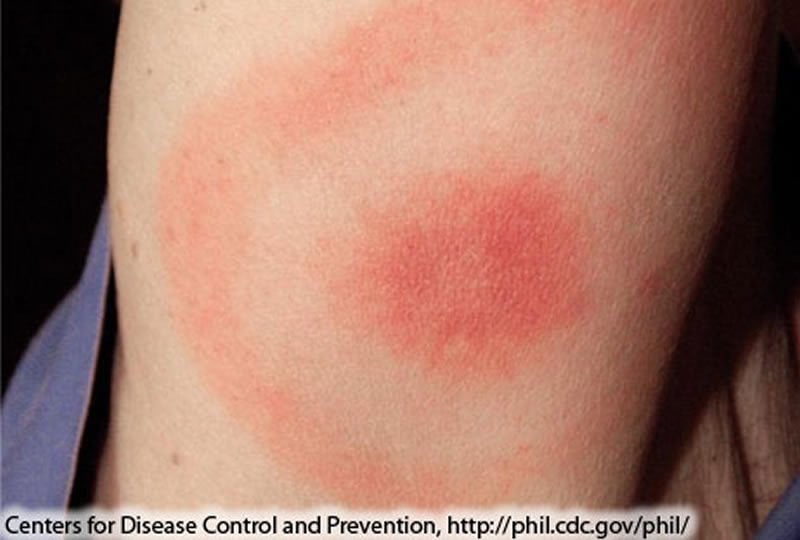 This shows the bullseye rash of lyme disease