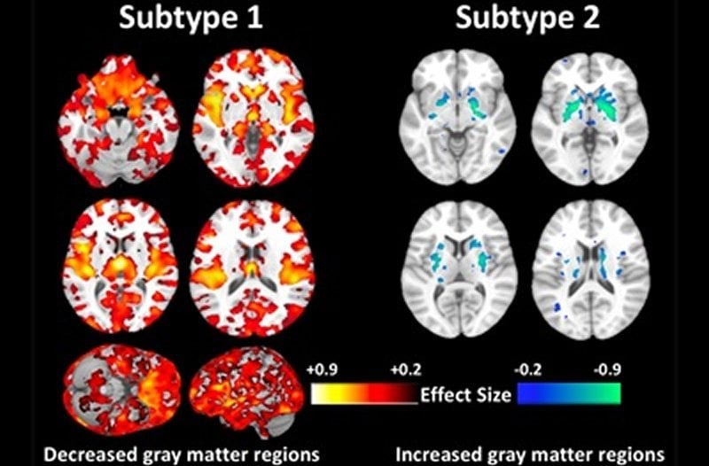 This shows brain scans from the study