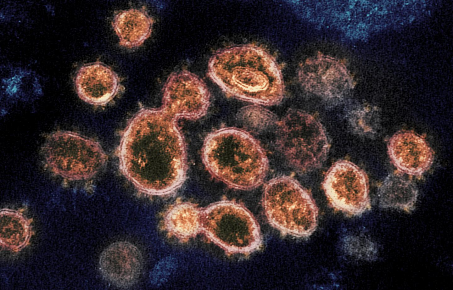 This transmission electron microscope image shows SARS-CoV-2 viruses