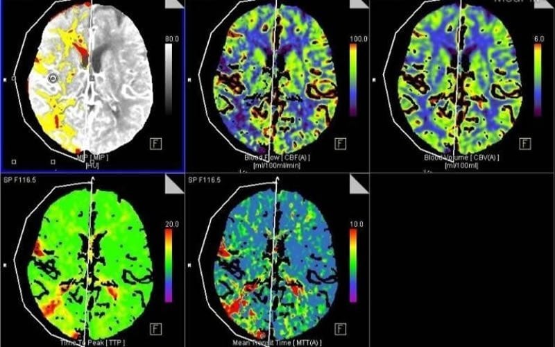 This shows brain scans of a stroke patient