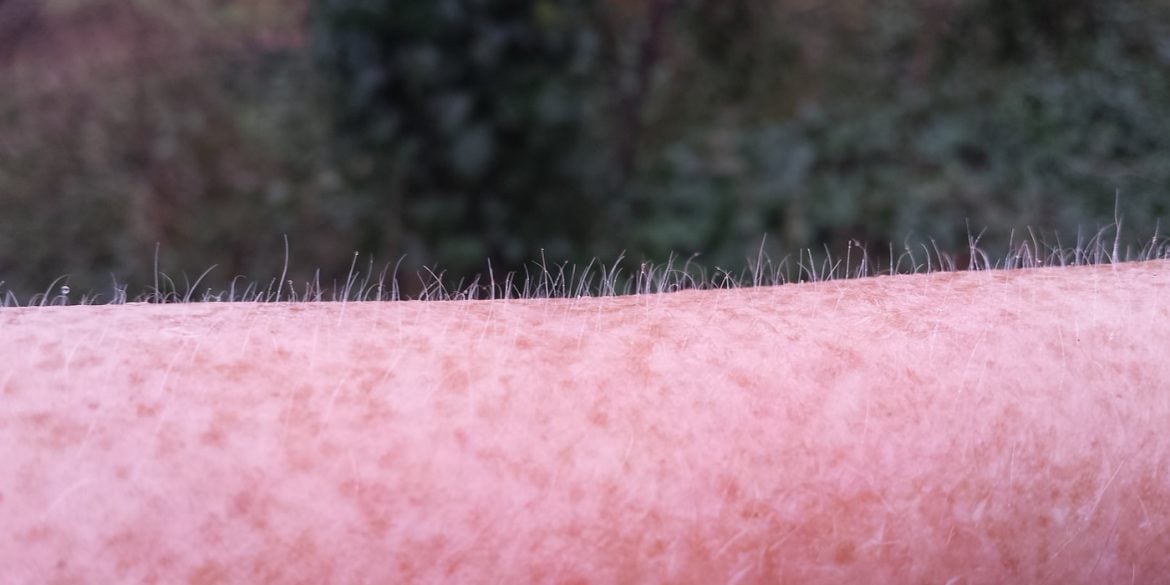 This shows goosebumps on a person's arm