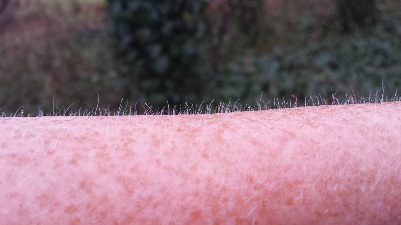 Goosebumps Skin Disease