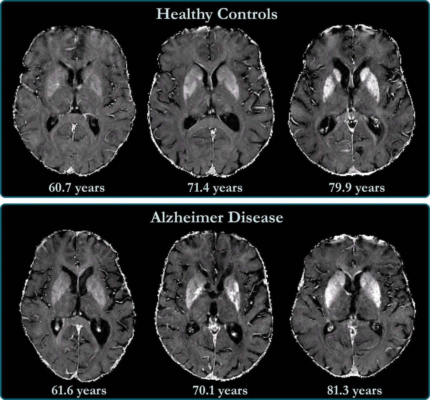 Brain Iron Accumulation Linked to Cognitive Decline in Alzheimer's