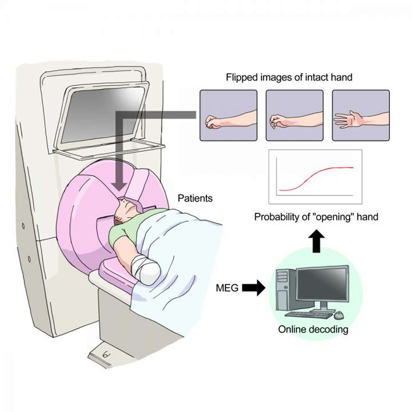 Next-gen Device Could Relieve Phantom Limb Pain