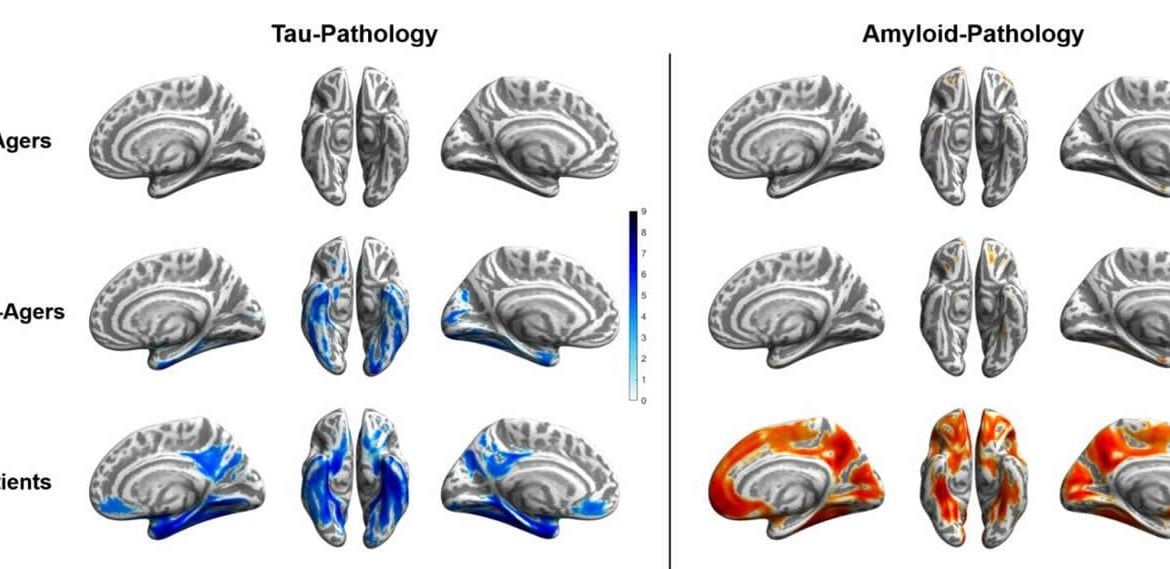 This shows brain scans from the study