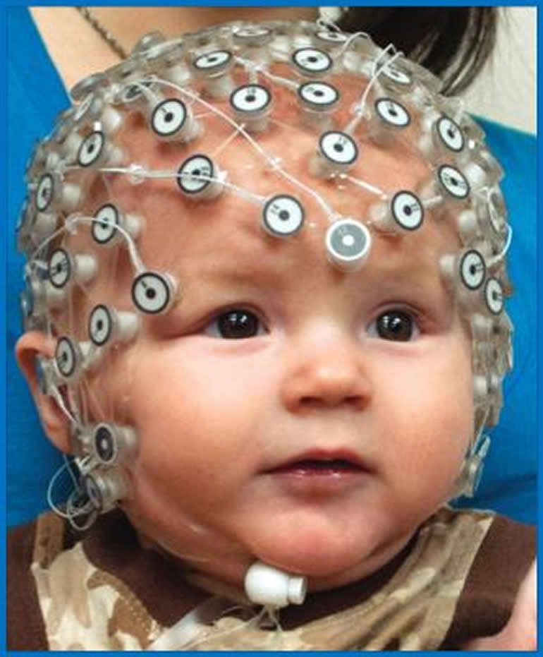 This shows a baby in an EEG helm