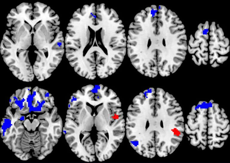 what-is-obsessive-compulsive-disorder-frontiers-for-young-minds