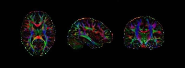 This shows brain scans from the study