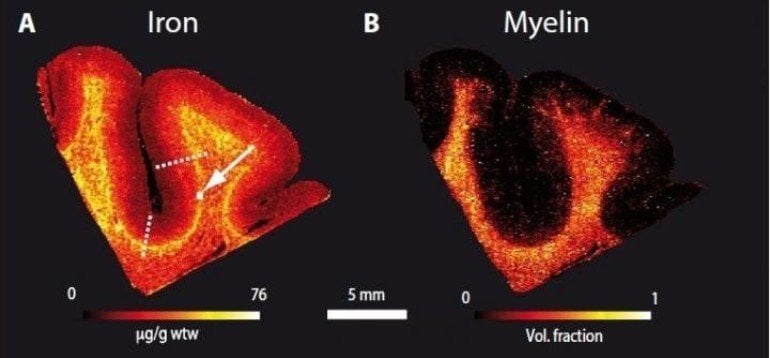 This shows a brain slice with a border between white and gray matter