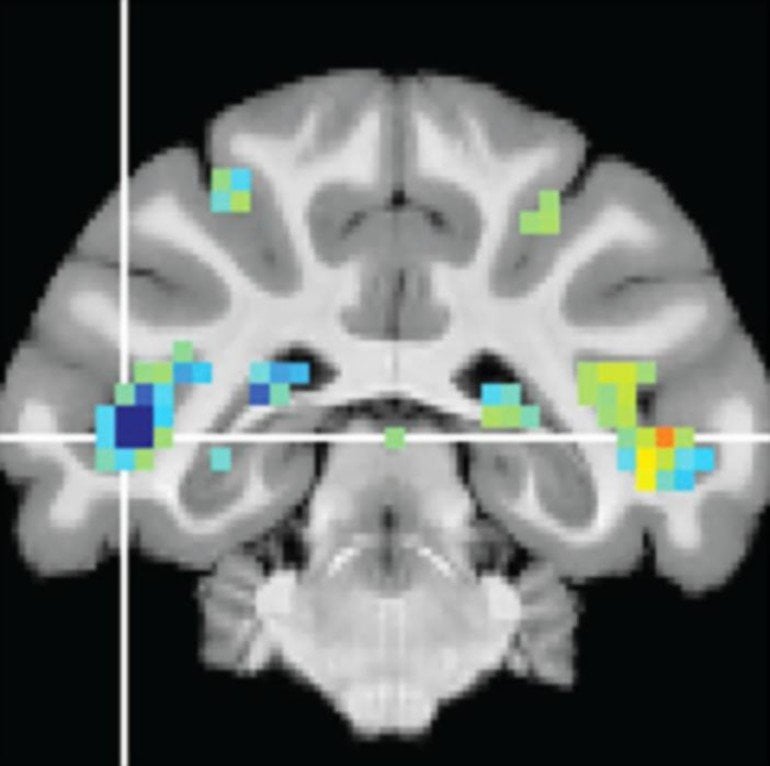 This shows a brain scan from the study
