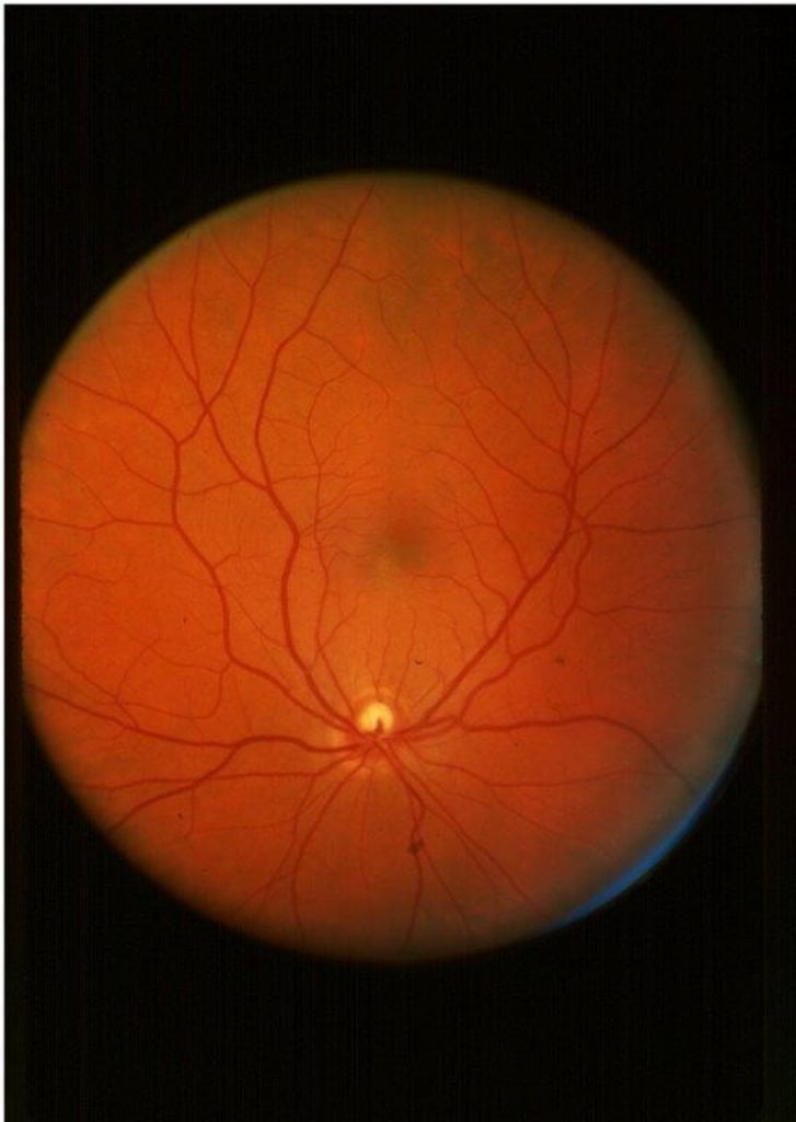 This shows a retinal scan