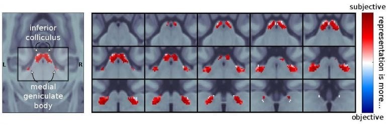 This shows brain scans