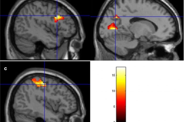 This shows brain scans from the study