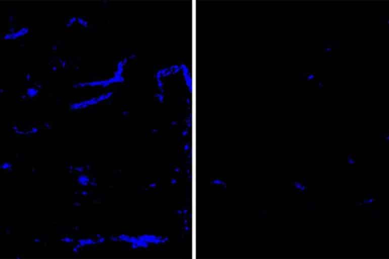 This shows two brain tissue samples, one with amyloid and another after treatment to remove the amyloid