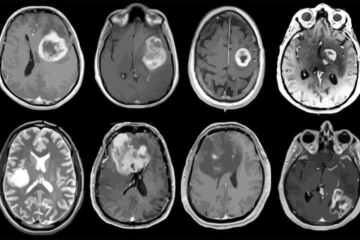 This shows brain scans from glioblastoma patients