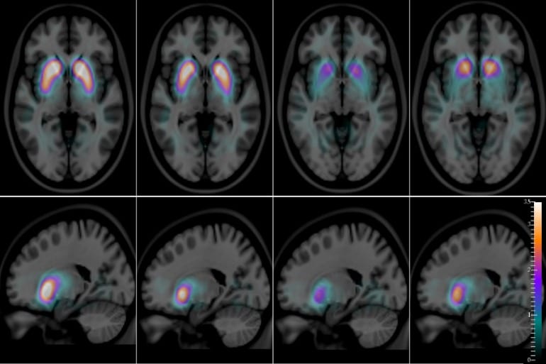 This shows brain scans of people with alzheimers and lbd