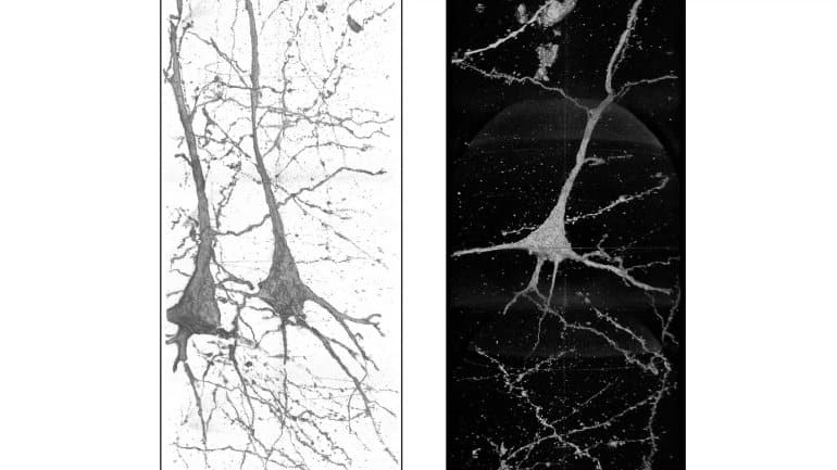 This shows neurons from a schizophrenia patient
