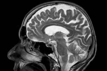 This shows a brain scan