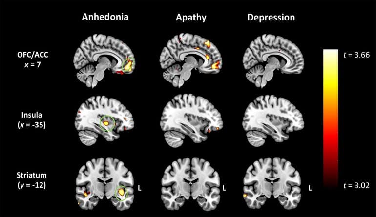 This shows brain scans from the study