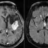 This shows two brain scans from a glioblastoma patient