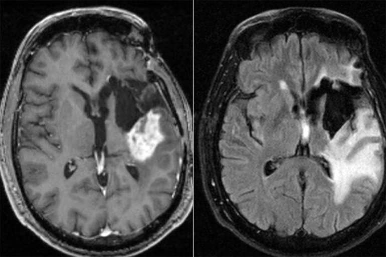 This shows two brain scans from a glioblastoma patient