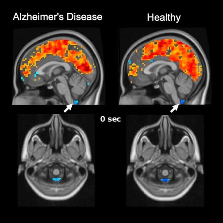 Role Of Sleep Related Brain Activity In Clearing Toxic Proteins And