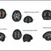 Isso mostra diferentes imagens do cérebro com áreas de mudança destacadas