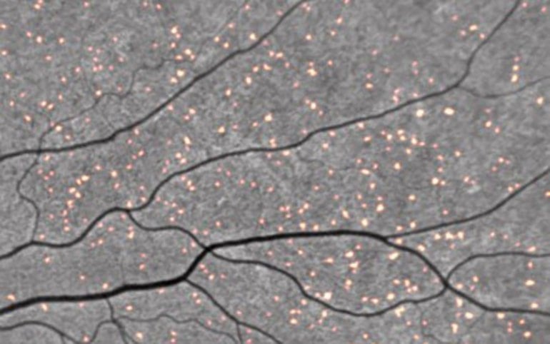 This shows ab deposits in the retina