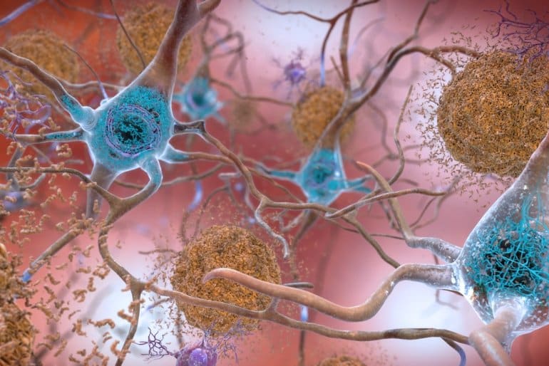 This is an illustration of neurons, amyloid plaques and tau