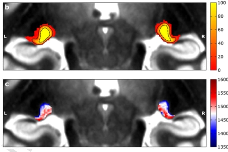 This shows the location of the visual sensory thalamus in the brain