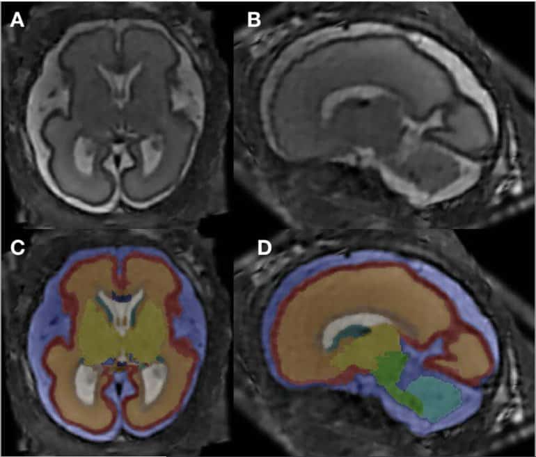 This shows the fetal brain scans