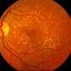 Aceasta arată o scanare a retinei cu semne de amd