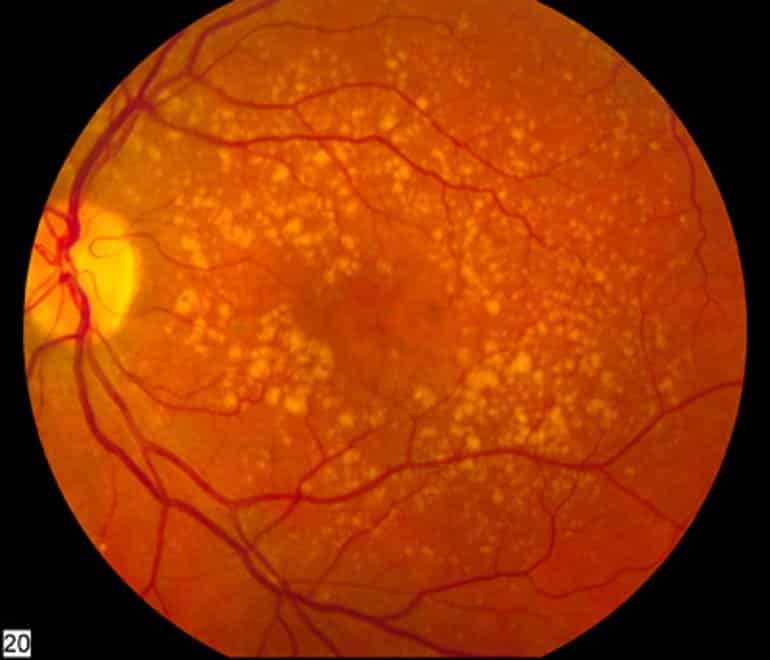 This shows a retinal scan with signs of amd