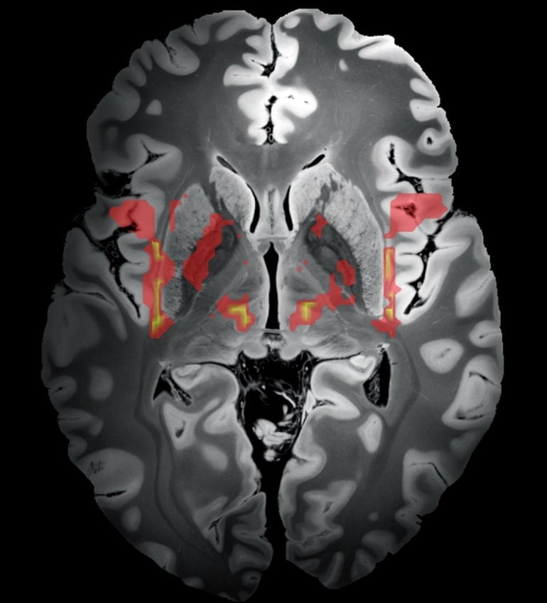 This shows a brain scan with the neural network associated with tic development highlighted