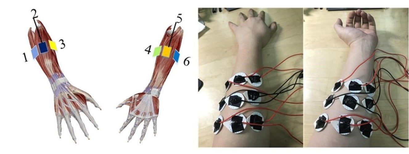 Long-term use of prosthetic limbs does not remap brain, study