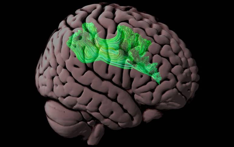 This shows the white matter tract in the brain's reading network